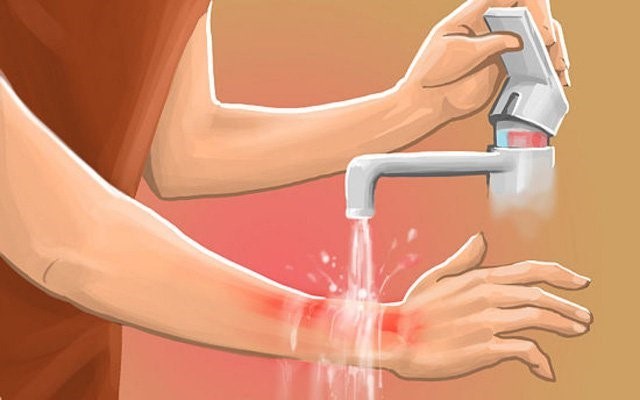 Sơ cứu khi bị bỏng nước sôi - ngâm rửa phần bị bỏng dưới vòi nước