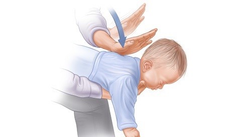 Sơ cứu trẻ sơ sinh khi bị hóc dị vật